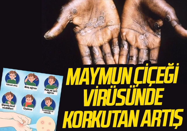 Maymun çiçeği virüsünde korkutan artış